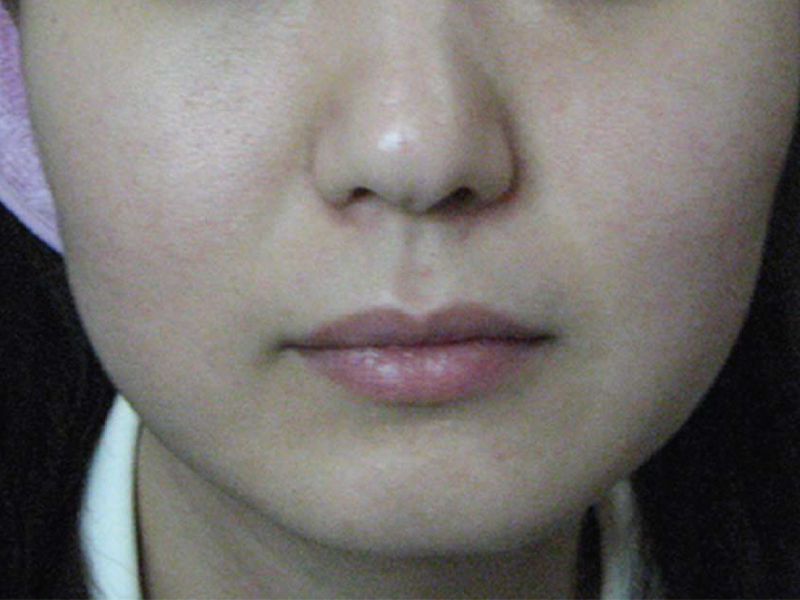ult_0003_Before After-Ultratech-A-1