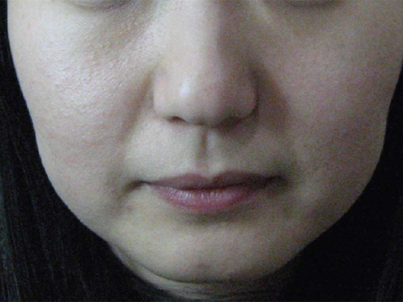 ult_0003_Before After-Ultratech-A-1